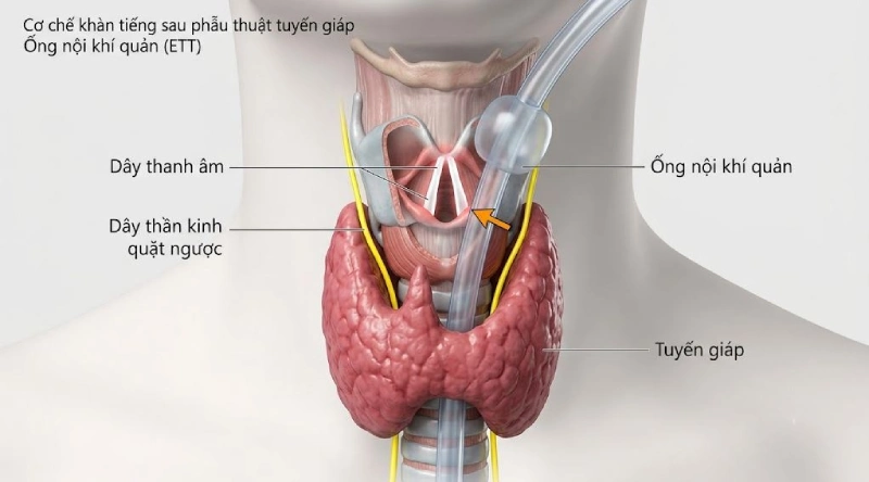 Tại sao mổ tuyến giáp xong bị khàn tiếng, hụt hơi?